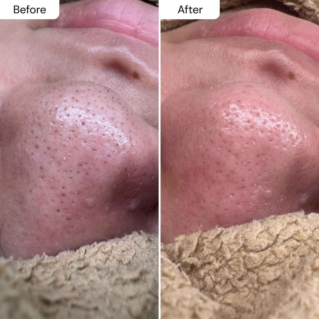 PUREPORE - WORLDS #1ST BLACKHEAD DISSOLVER