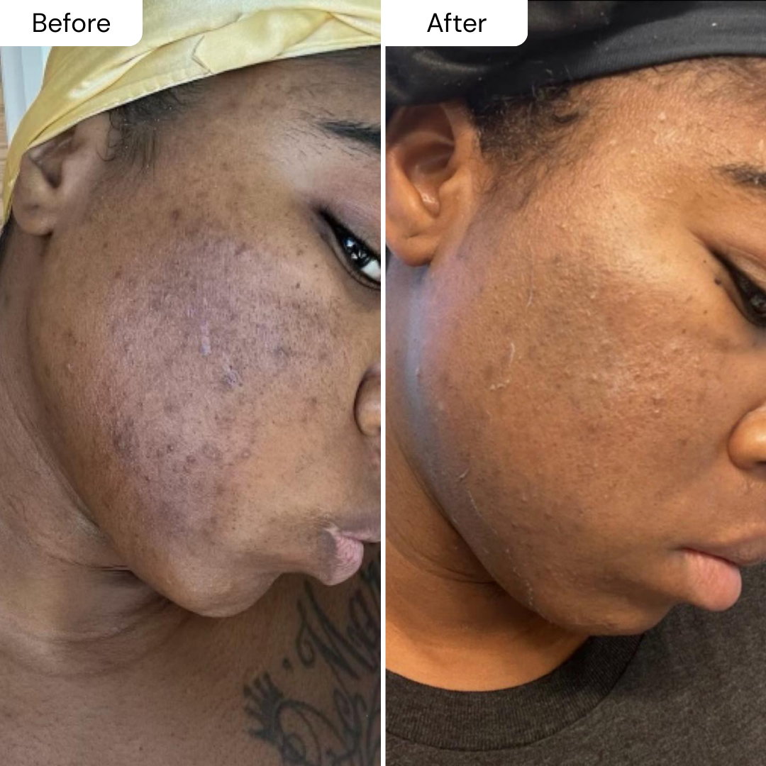 PUREPORE - WORLDS #1ST BLACKHEAD DISSOLVER